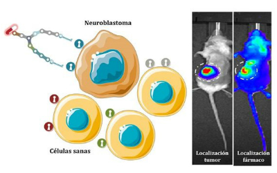 Neuroblastoma